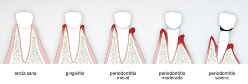 Qué pastas de dientes quitan el sarro