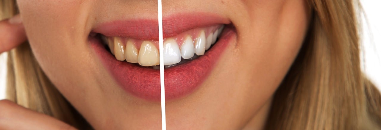 Tipos de blanqueamiento dental para casa